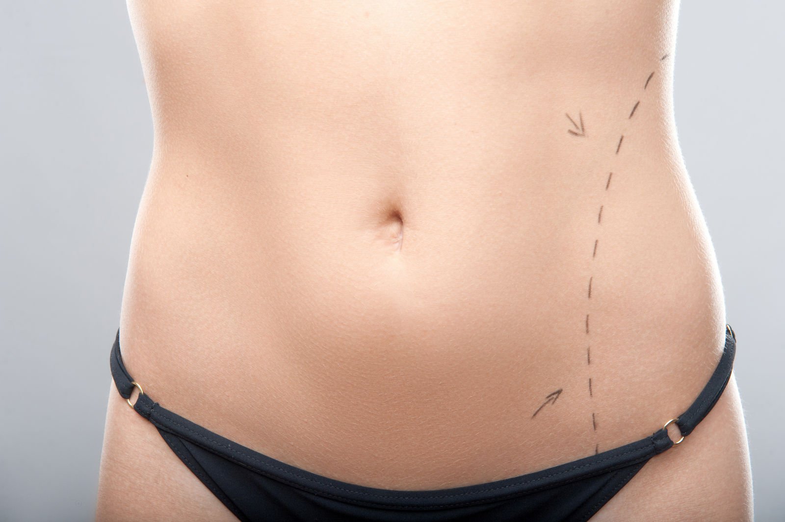 Will health insurance pay for liposuction?